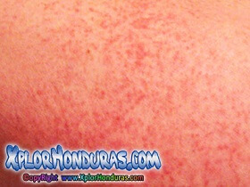 Fiebre Chikungunya en Honduras